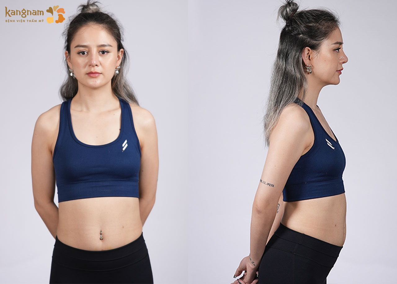 Vòng 1 và body của chị Bom trước khi thẩm mỹ