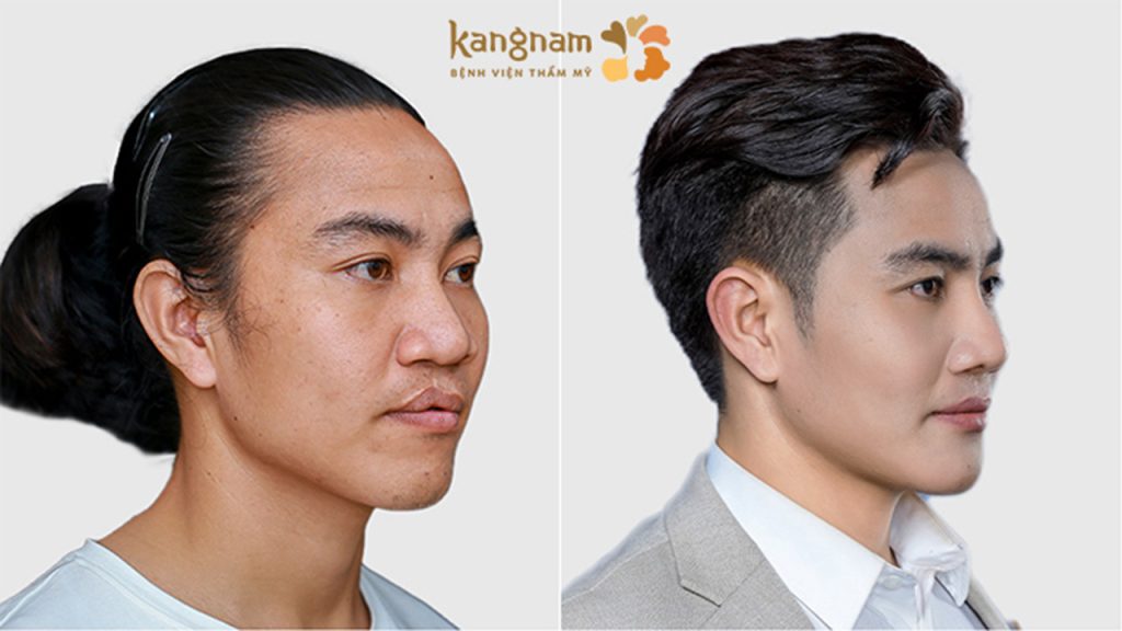 Trải qua 02 cuộc phẫu thuật, chàng trai “sứt môi” hóa nam thần