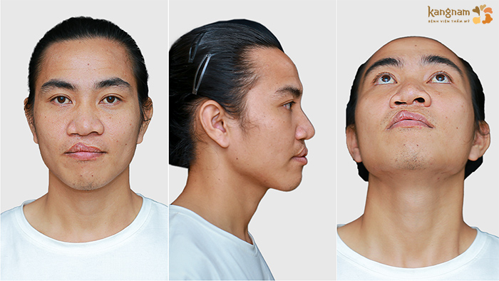 Trần Văn Tự gặp tình trạng sứt môi, mũi biến dạng do di chứng sứt môi hở hàm ếch từ nhỏ