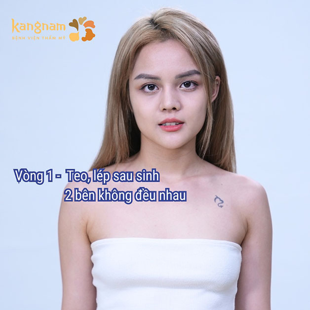 Fansie với tình trạng vòng 1 teo lép, hai bên ngực xa nhau, thiếu cân xứng