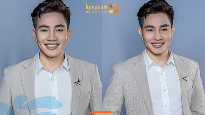 “Hoàng tử ếch” lột xác ngoạn mục