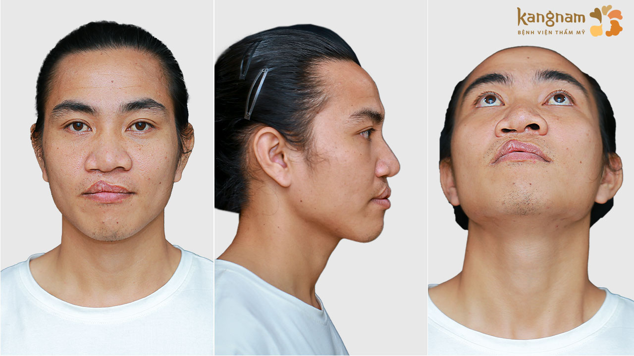 Tình trạng sứt môi - hở hàm ếch 