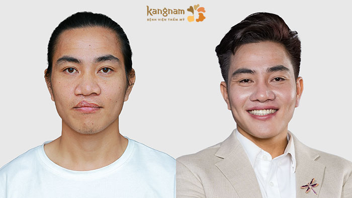 Trần Văn Tự tỏa sáng sau khi được phẫu thuật thẩm mỹ