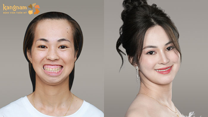 Khuôn mặt xinh đẹp, nụ cười tươi thay thế cho hàm hô kém sắc