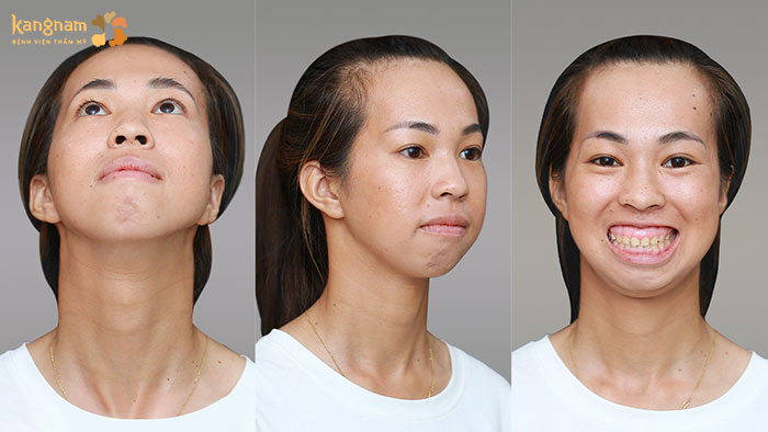 Kim Phượng gặp tình trạng hàm hô, thiểu sản cấu trúc hàm dưới