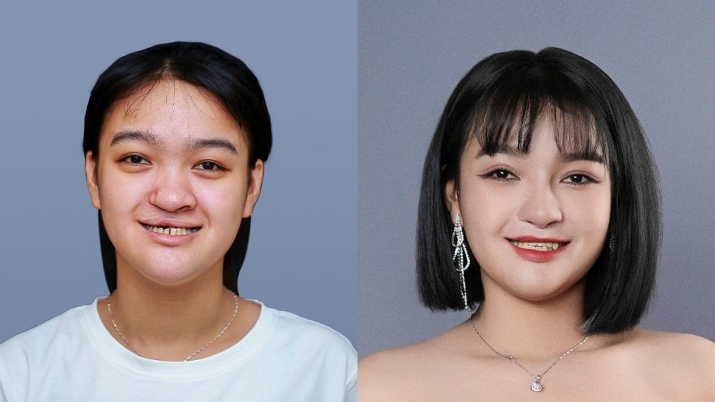 Bùi Thị Như Cảnh – Cô bé sứt môi hở hàm ếch và 2 cuộc phẫu thuật thay đổi nhan sắc