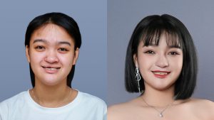 Bùi Thị Như Cảnh – Cô bé sứt môi hở hàm ếch và 2 cuộc phẫu thuật thay đổi nhan sắc