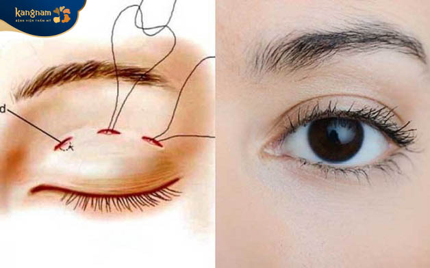 Bấm mí được đánh giá là an toàn