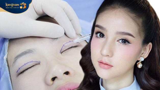 Bác sĩ xác định được chính xác các điểm để bấm mí