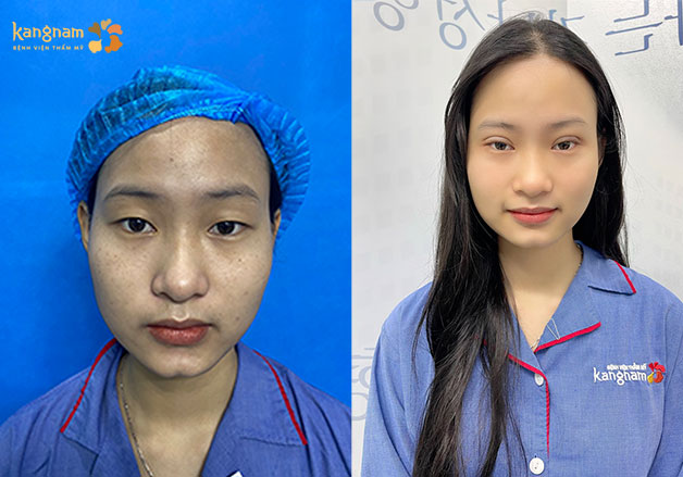 Đôi mắt to tròn tự nhiên sau khi bấm mí tại Kangnam