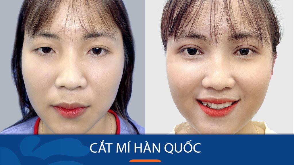 Cắt mí Hàn Quốc là gì? Đối tượng phù hợp, quy trình và chi phí