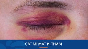 Cắt mí mắt bị thâm: Nguyên nhân và cách trị thâm mắt nhanh nhất
