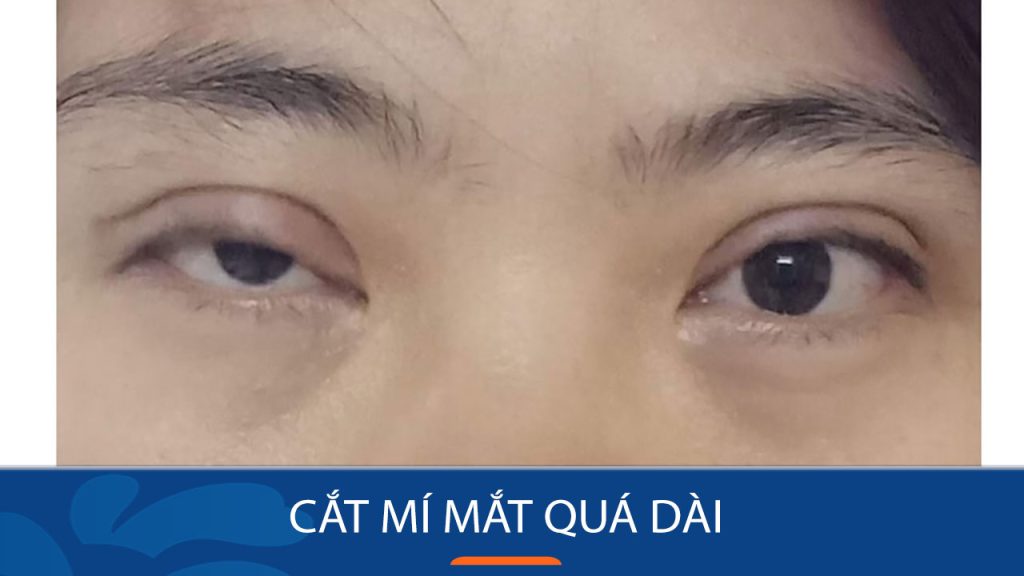 Cắt mí mắt quá dài là gì? Nguyên nhân & cách khắc phục an toàn