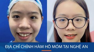 Chỉnh hàm hô móm kangnam tại Nghệ An