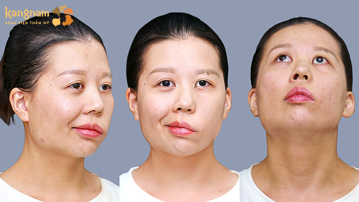 TS.BS Richard Huy trải lòng về ca chỉnh hình di chứng sau liệt dây thần kinh 7