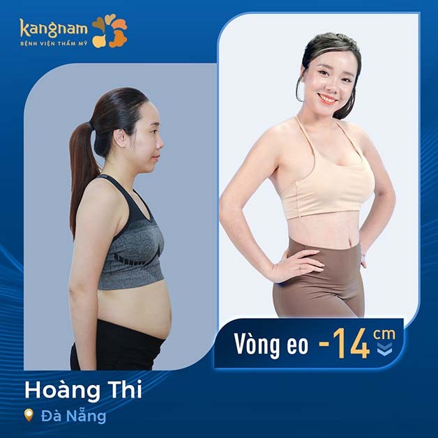 Khách hàng Hoàng Thi lấy lại vòng eo “con kiến” sau khi hút mỡ bụng