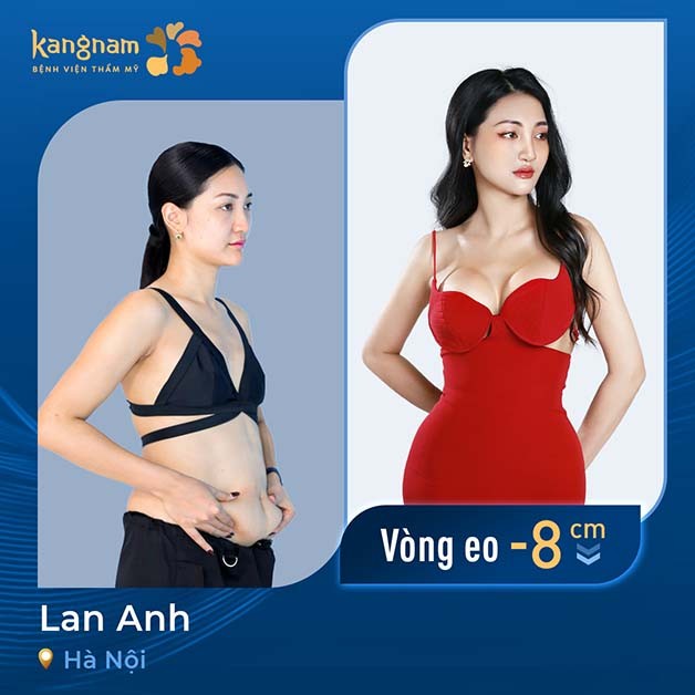 Hút mỡ bụng duy trì kết quả lâu dài nếu có lối sống lành mạnh