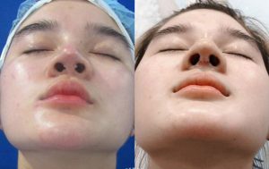 Những màn thay đổi nhan sắc ấn tượng nhờ bàn tay Dr.Lucas Hoàng