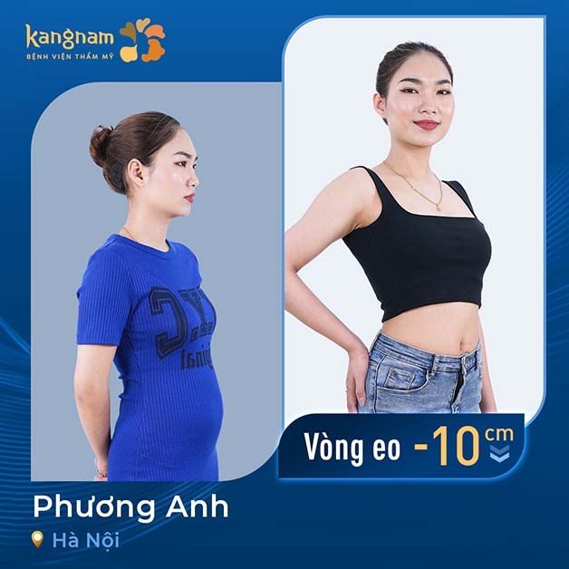Phương Anh giảm 10cm vòng eo sau khi hút mỡ bụng