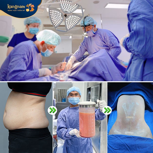 Kangnam là địa chỉ hút mỡ bụng an toàn, uy tín