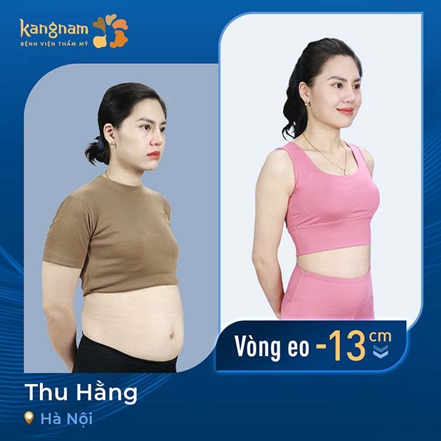 Thu Hằng giảm 13cm vòng bụng sau khi hút mỡ tại Kangnam