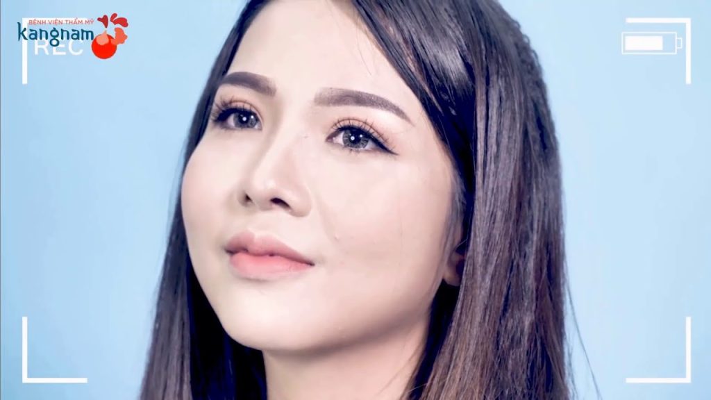 Nhật ký sửa mũi ngắn, hếch bẩm sinh của Mai Anh