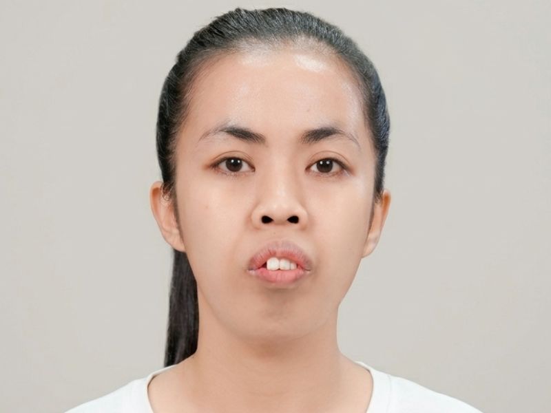 Ảnh chụp trước khi phẫu thuật thẩm mỹ của Trương Thị Trà My tại Bệnh viện Thẩm mỹ Kangnam. Gương mặt thể hiện rõ tình trạng hốc hác, gầy gò, gò má cao, rãnh cười sâu và mí mắt không đều. Nhìn tổng thể khuôn mặt thiếu cân đối và trông già dặn hơn tuổi 24.