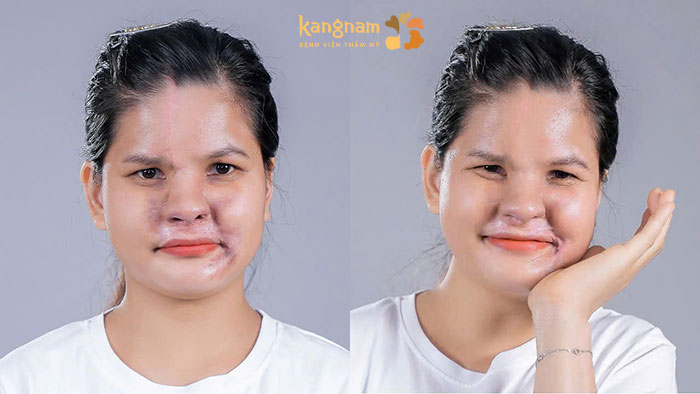 Sau 7 tháng Lệ đã sở hữu dáng mũi đẹp, cân đối và tự nhiên