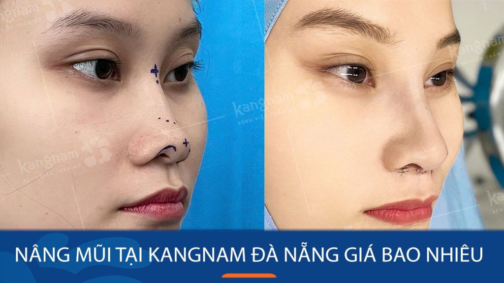 Nâng mũi tại Kangnam Đà Nẵng