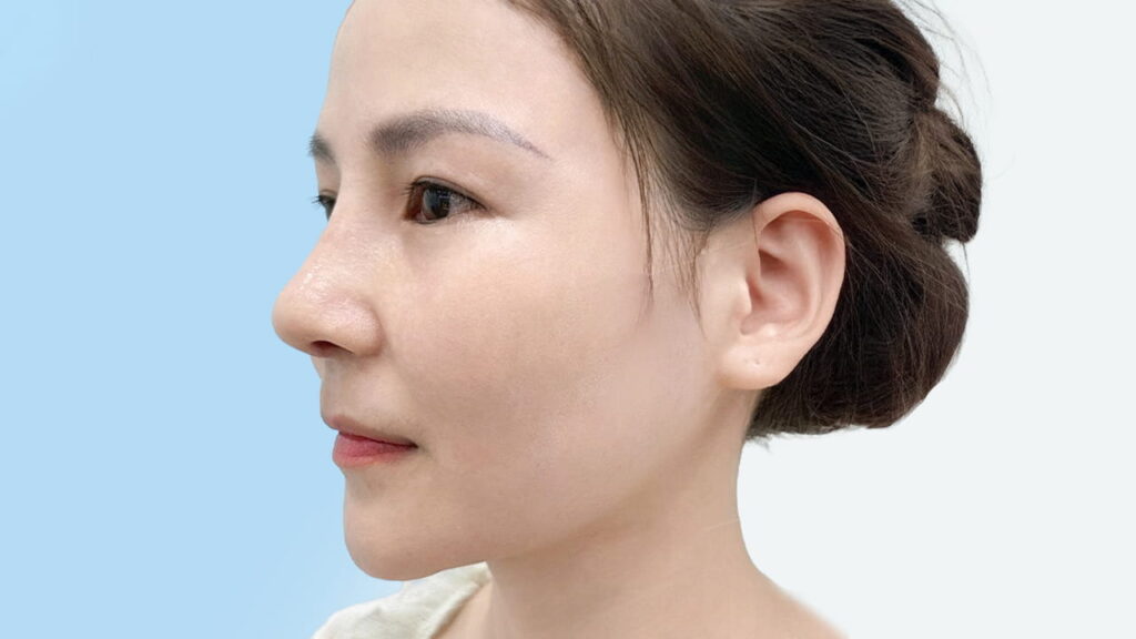 Cắt cánh mũi có mất lộc không? Góc nhìn chuyên gia