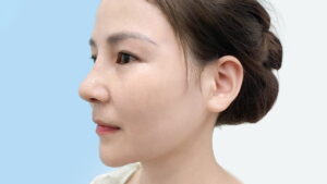 Cắt cánh mũi có mất lộc không? Góc nhìn chuyên gia