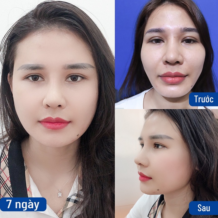 Những trường hợp cấy mỡ bị lệch, không đều nên thực hiện chỉnh sửa để gương mặt được cân đối, tự nhiên hơn