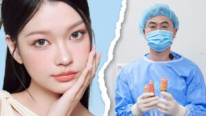 3 câu hỏi về cấy mỡ được quan tâm nhất