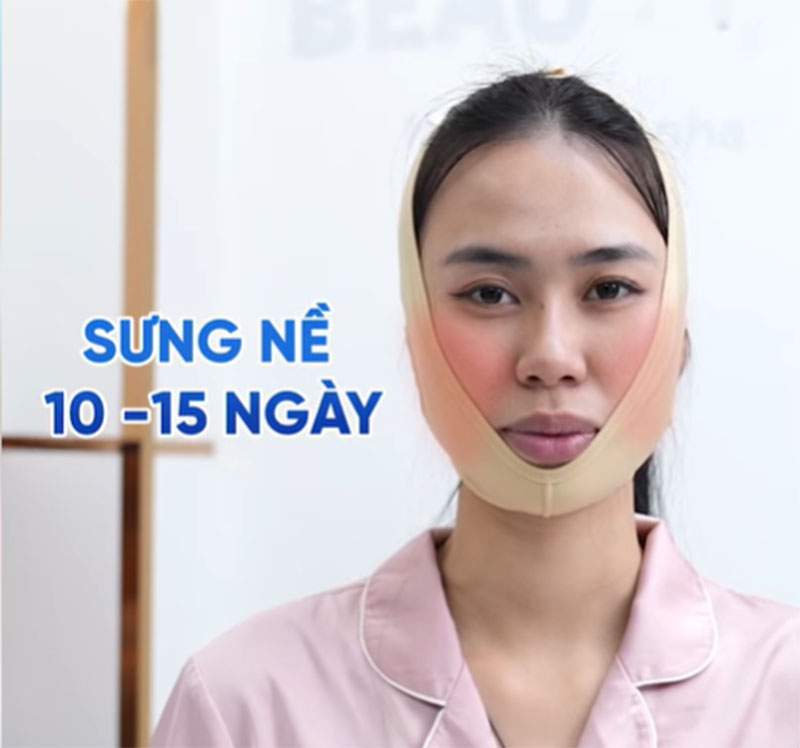 Sưng nề sau khi chỉnh hình hàm mặt là hiện tượng bình thường