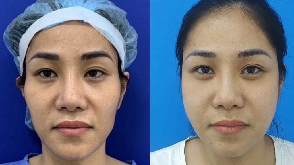 Cấy mỡ tự thân có được vĩnh viễn không?