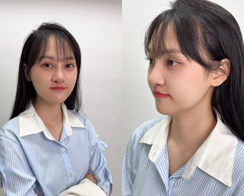 Minh Xuân “lột xác” ngoạn mục sau 2 cuộc phẫu thuật tại Thẩm mỹ Kangnam