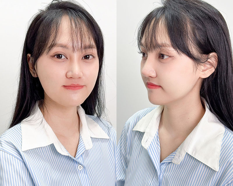 Gương mặt Minh Xuân sau 2 lần phẫu thuật, khuôn hàm cân đối, sống mũi cao hài hòa