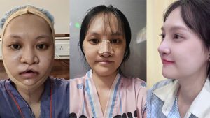 Nhật ký “lột xác” của Minh Xuân – cô nàng bị dị tật sứt môi hở hàm ếch bẩm sinh