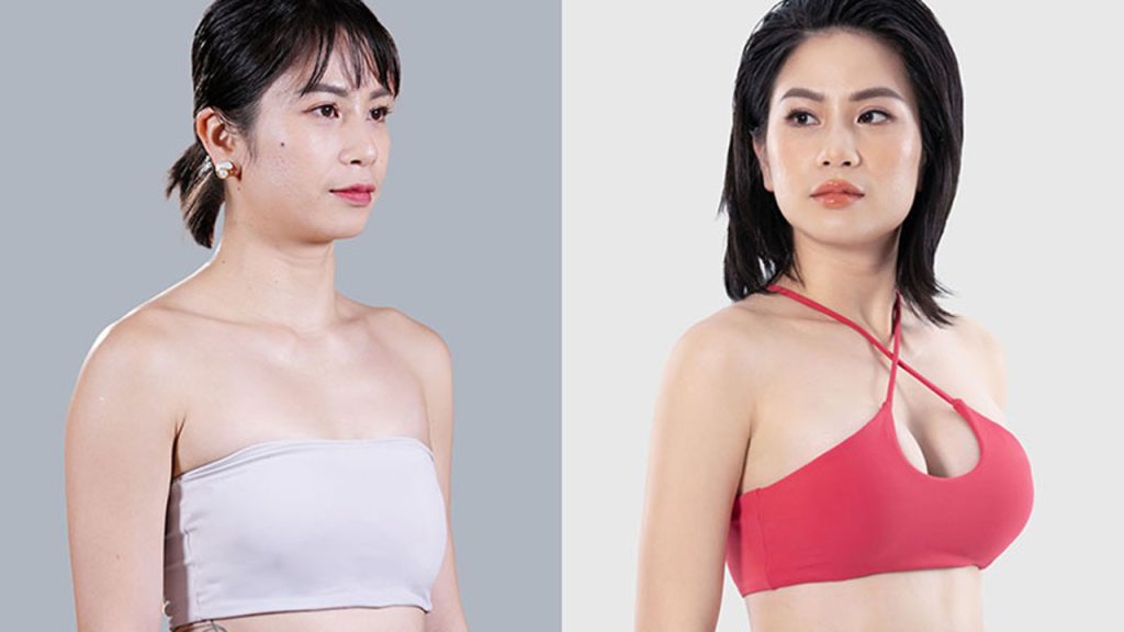 Nâng ngực duy trì được bao lâu? Cách chăm sóc để giữ form ngực lâu dài