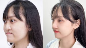 Hành trình “biến hóa” ngoạn mục của cô gái hàm ếch Minh Xuân