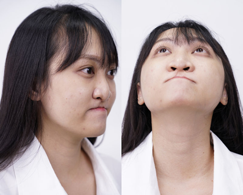 Dù đã trải qua 2 lần phẫu thuật nhưng gương mặt của Xuân chưa mấy cải thiện