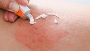 Tác hại của triệt lông vĩnh viễn ít ai để ý tới