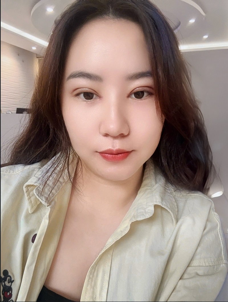 Sau 7 ngày nếp mí đã hết sưng và tự nhiên hơn