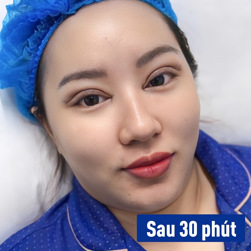 Sau khi vừa cắt mí được 30 phút