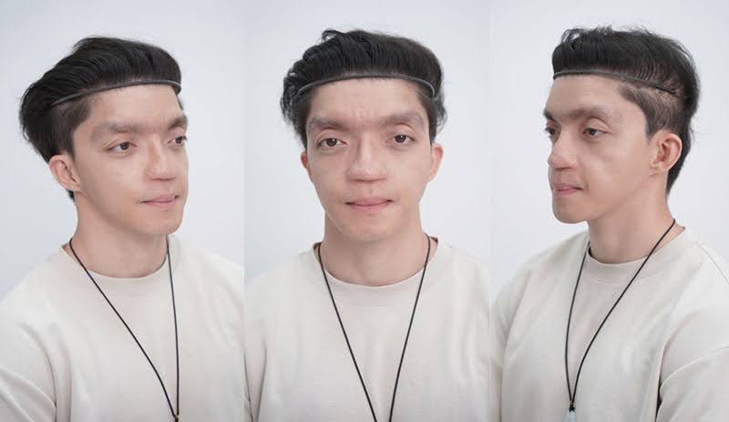 Tình trạng gương mặt nhiều khiếm khuyết của Mavis Trương do bị tật bẩm sinh