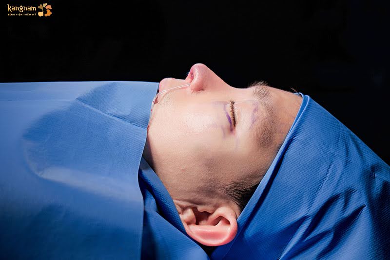 Dáng mũi của Mavis Trương sau phẫu thuật, sống mũi cao nam tính