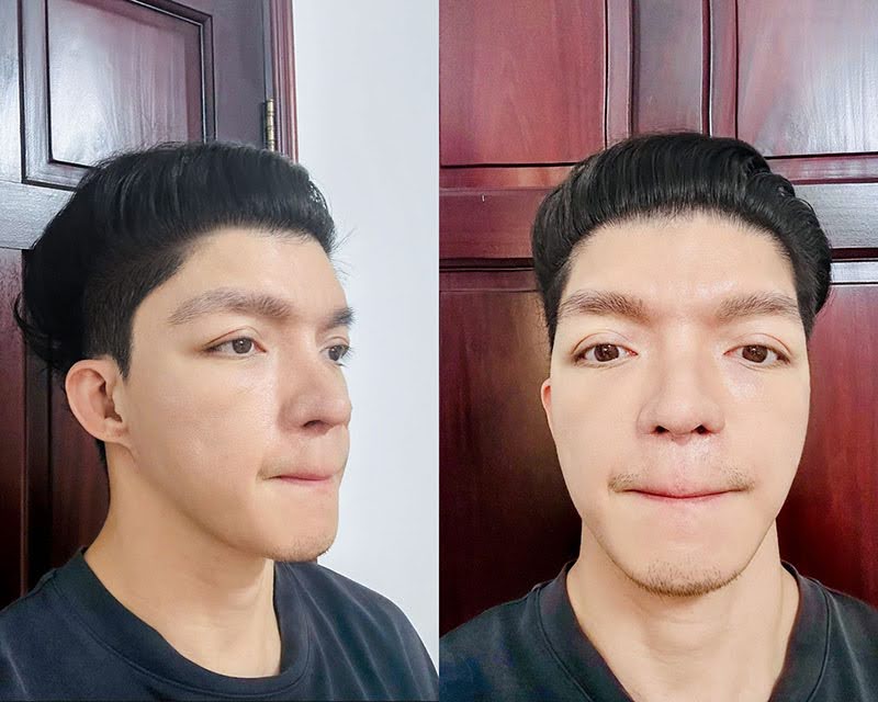 Diện mạo của Mavis Trương sau ca đại phẫu và hồi phục cơ bản