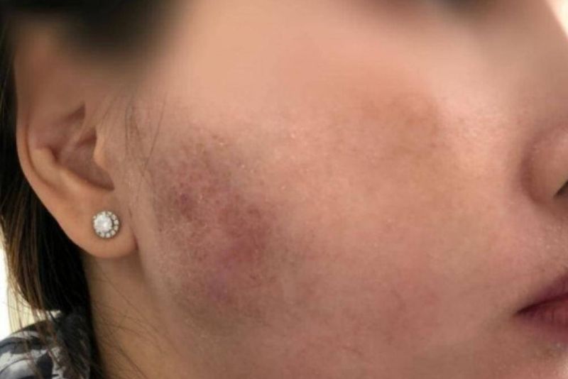 vùng da có dấu hiệu gồ ghề, lồi lõm hoặc biến dạng