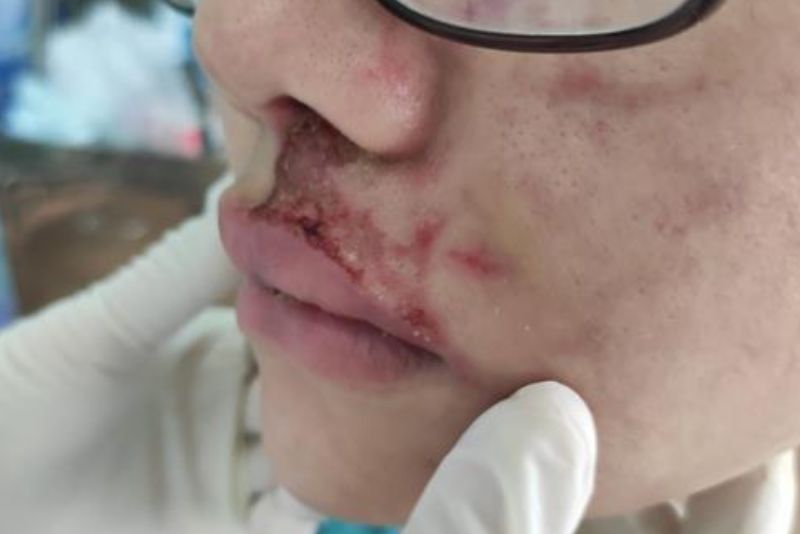 Hoại tử sau tiêm filler xảy ra khi chất làm đầy vô tình chèn ép hoặc đi vào mạch máu