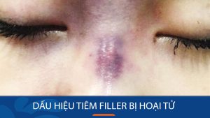 Cảnh báo: 6 Dấu hiệu tiêm filler bị hoại tử không nên bỏ qua